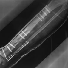 Metal Implants on a fractured bone | David Lee | flickr.com